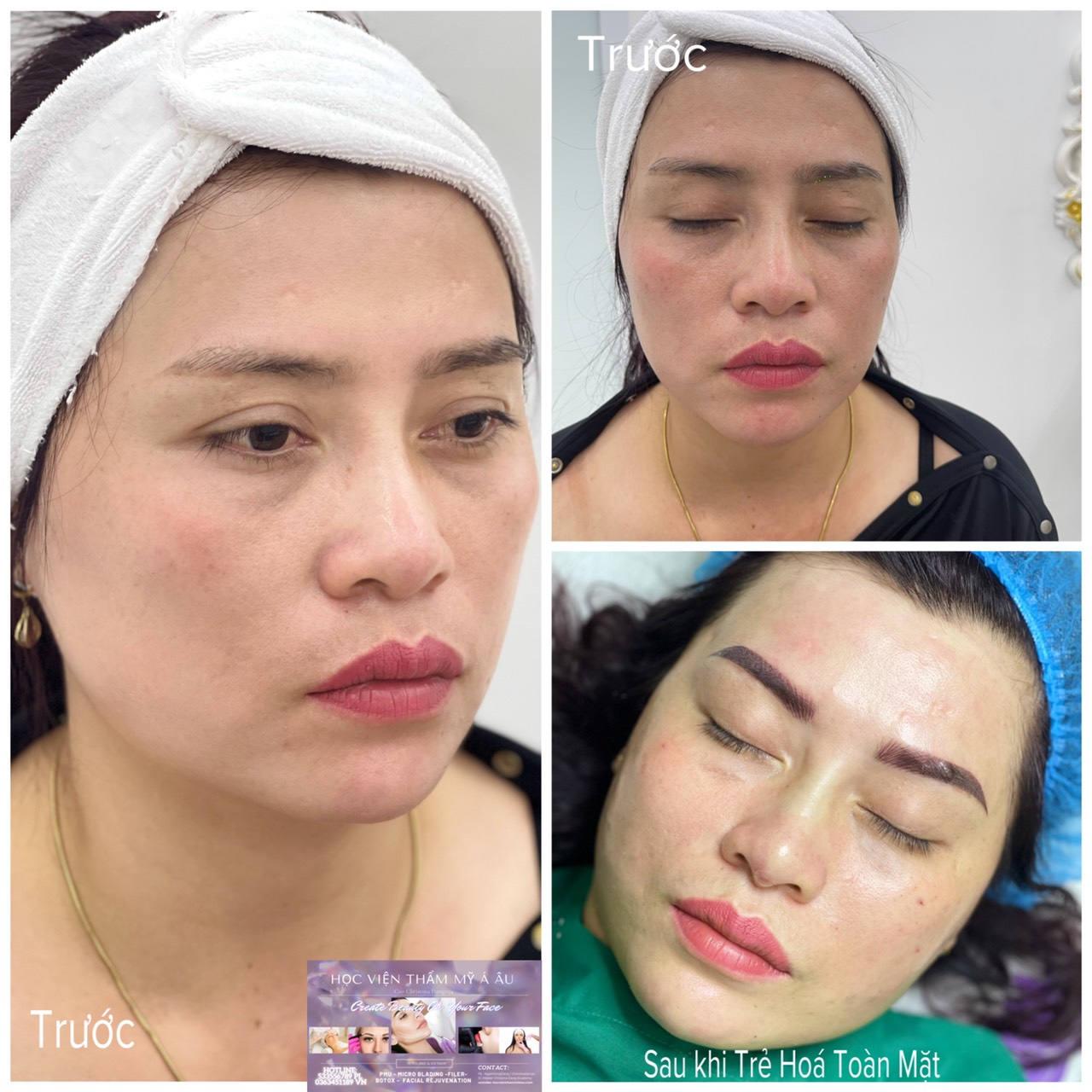 Filler Châu Âu Cao Cấp - Pháp Siêu Mềm