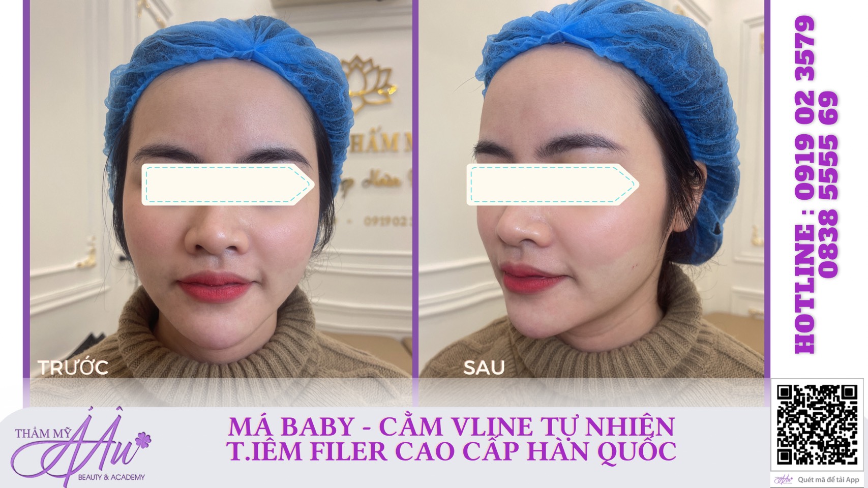 Filler Hàn Quốc - Hàn Cao Cấp 2