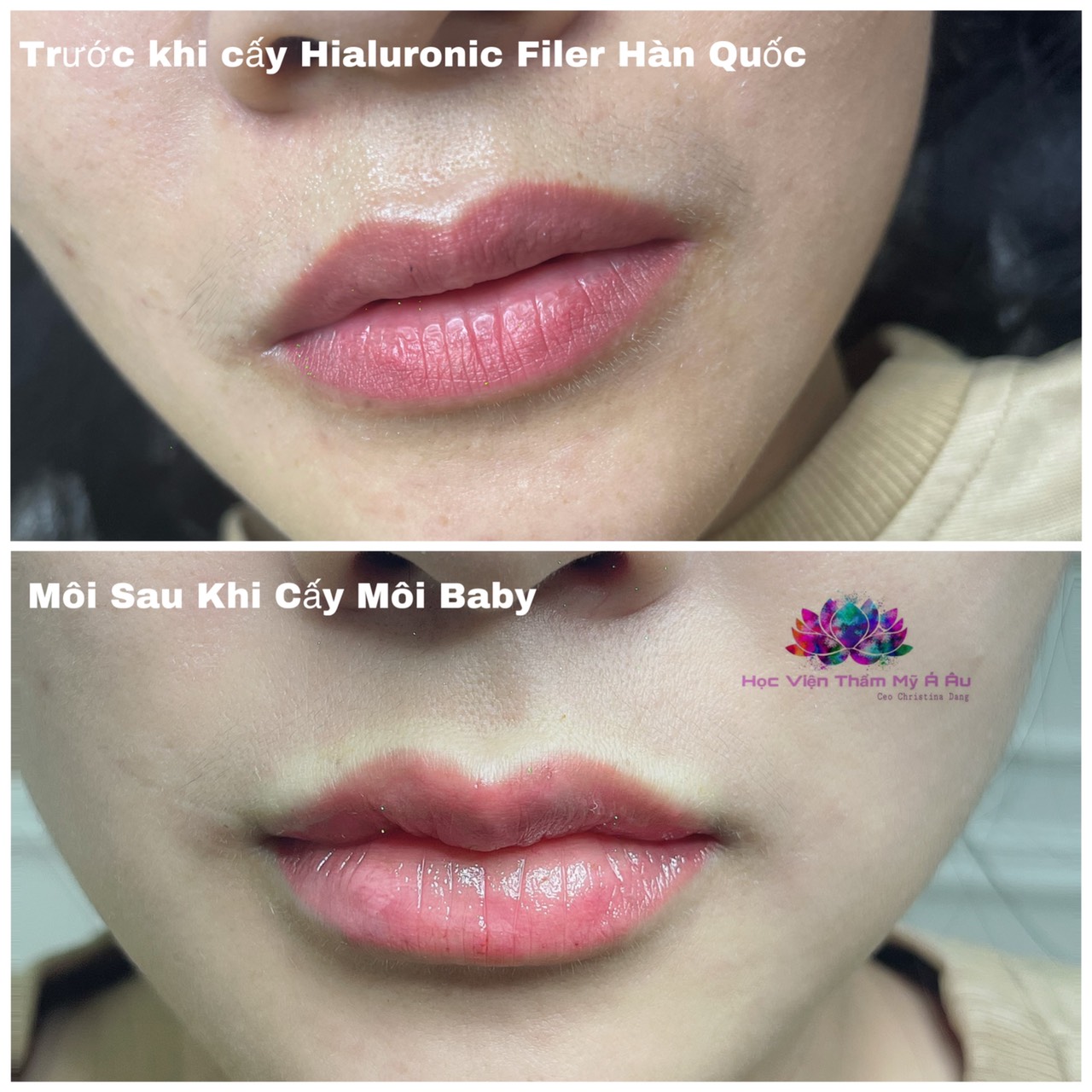 Filler Hàn Quốc - Hàn VIP Pro