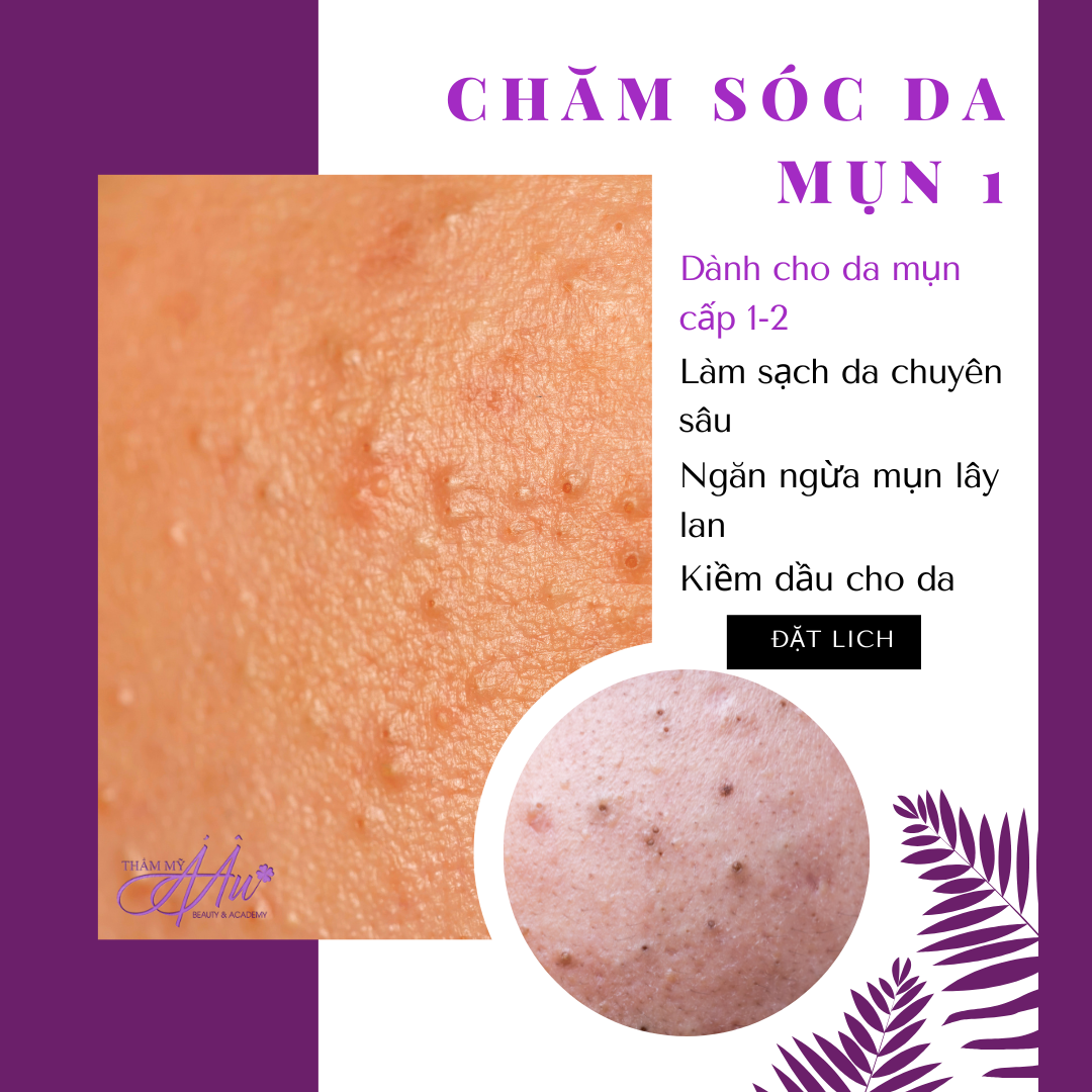 Chăm sóc Da Mụn 1